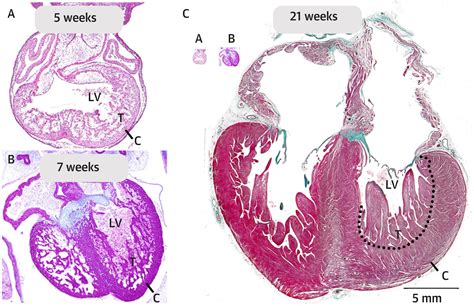 trabeculation of left ventricular myocardium